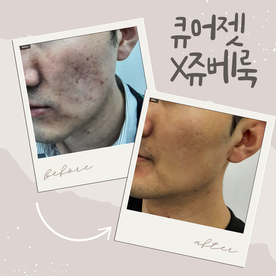 공덕 피부과, 큐어젯 쥬베룩으로 여드름 흉터 지우기 관련 이미지 1