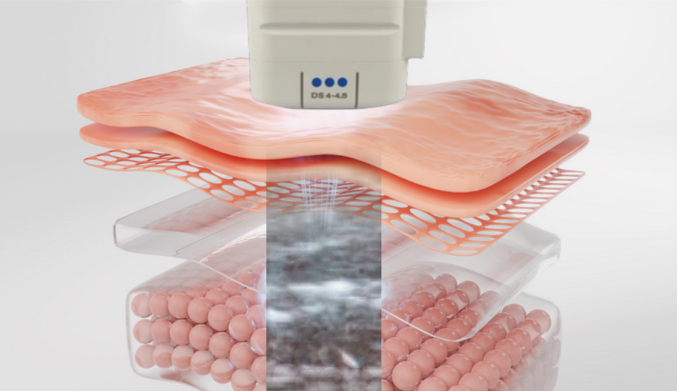 울쎄라피프라임, 실패 없는 리프팅을 위한 10가지 솔직 답변 관련 이미지 2