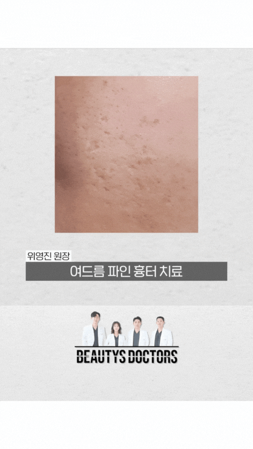 상암 피부과 큐어젯 쥬베룩으로 여드름 흉터개선 가능할까? 관련 이미지 2
