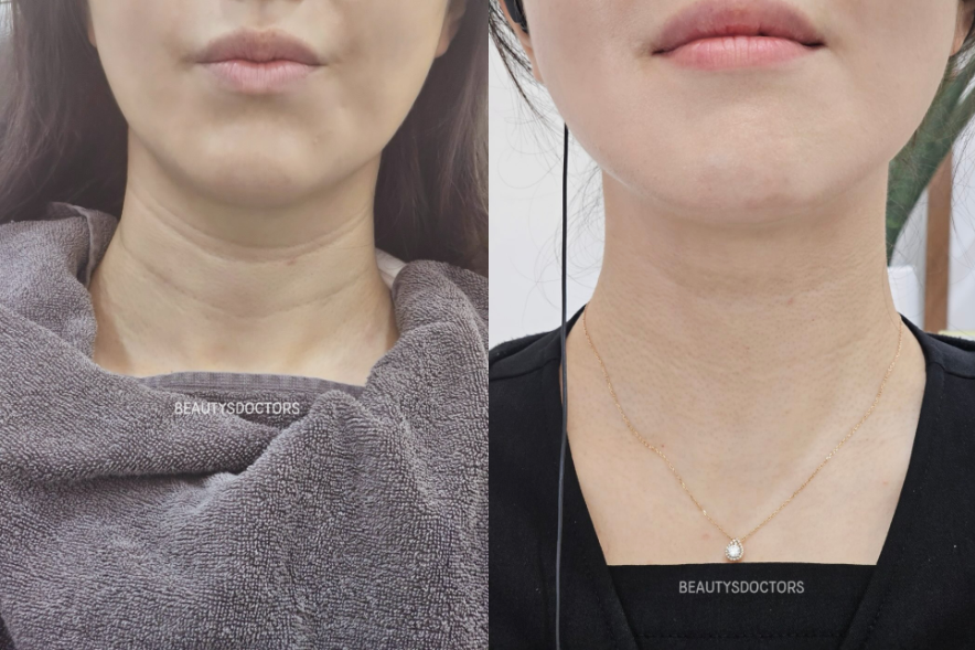 가로 세로목주름 관리법, 목주름 필러 시술 (feat.벨로테로 소프트) 관련 이미지 2