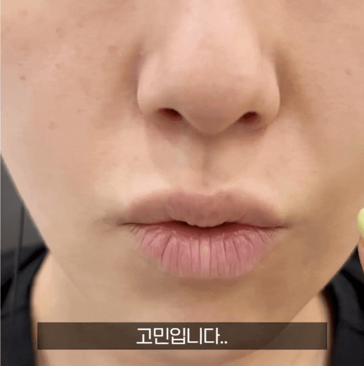 합정 피부과 리쥬란 힐러, 왜 아플까? 통증 줄이는 방법과 실제 효과 관련 이미지 2