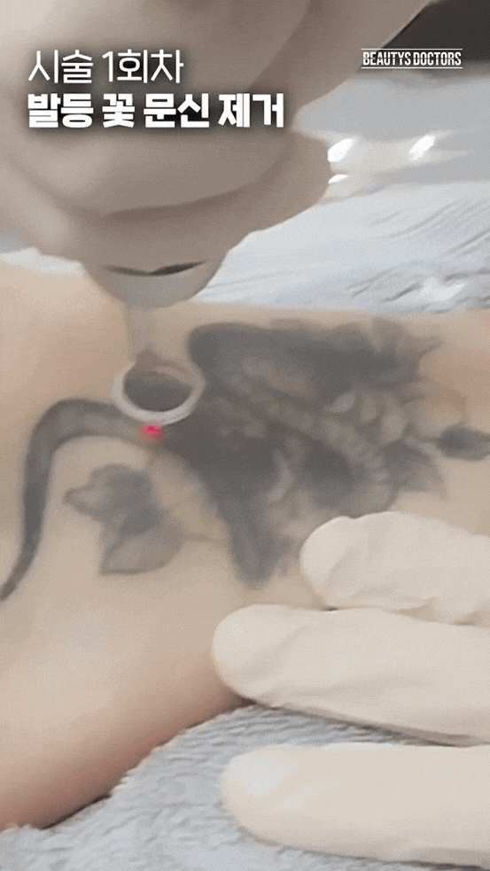 Mapo-gu Skin Clinic Tattoo Removal: Can You See Results From the First Session, and How Many Sessions Are Needed for Complete Removal? image 2