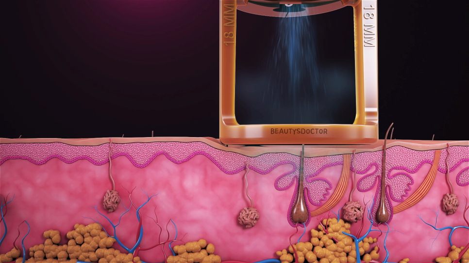 강서구 피부과 수염 제모 통증 줄이는 방법, 젠틀맥스프로플러스 관련 이미지 3