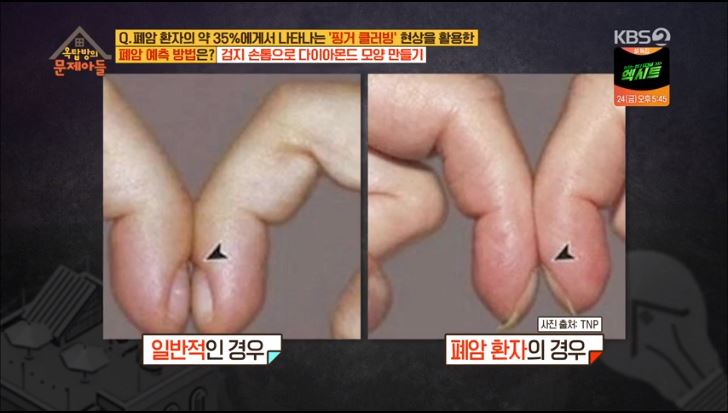 핑거클러빙, 간단한 폐암 자가진단하는 방법! 관련 이미지 4