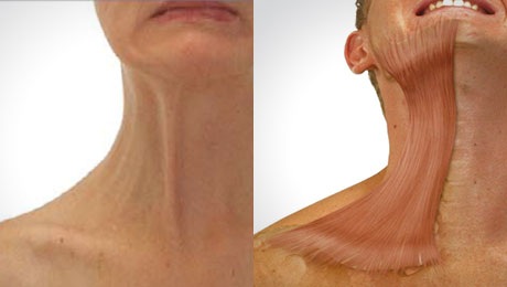 가로 세로목주름 관리법, 목주름 필러 시술 (feat.벨로테로 소프트) 관련 이미지 4