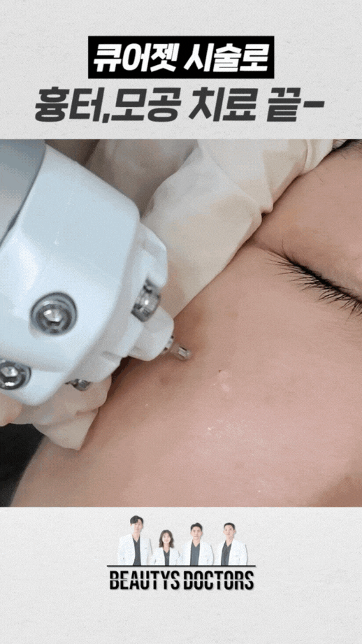 합정역 피부과, 큐어젯 쥬베룩으로 여드름 흉터개선 관련 이미지 3