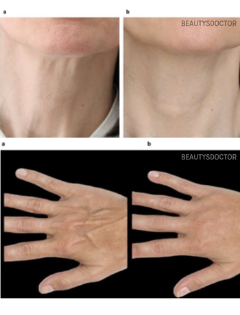 레디어스 효과, 콜라겐주사 제대로 알고 맞으세요, 부작용&middot;통증까지 관련 이미지 2