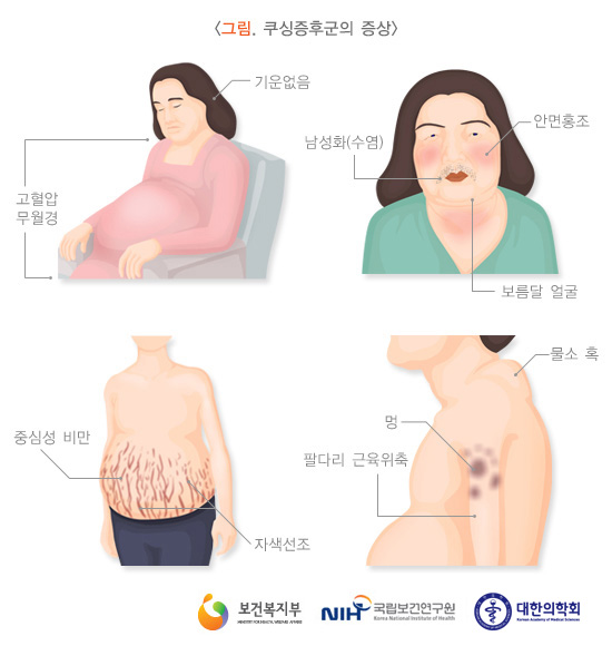 가수 이은하 쿠싱증후군, 급격한 20kg증량 쿠싱증후군 증상과 예방법 관련 이미지 6