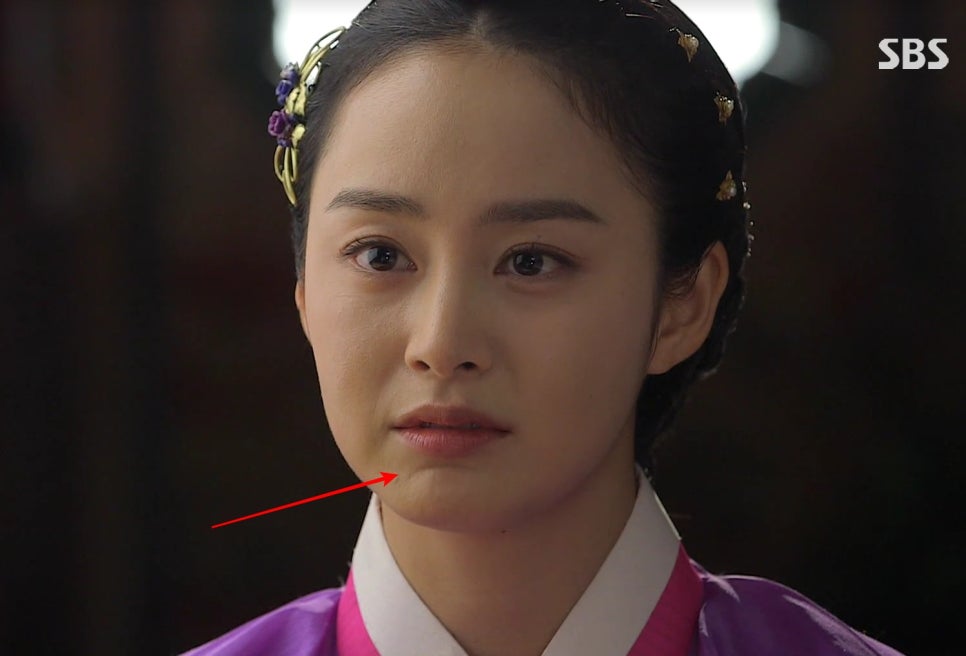 호두주름, 호두턱, 자갈턱 보톡스로 입술 밑선 예방하기 관련 이미지 2