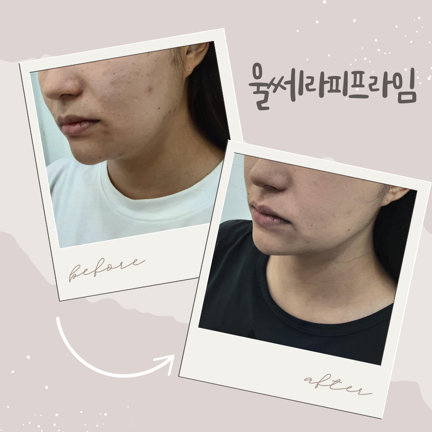 서울 울쎄라 효과, 언제부터 체감될까요 관련 이미지 1