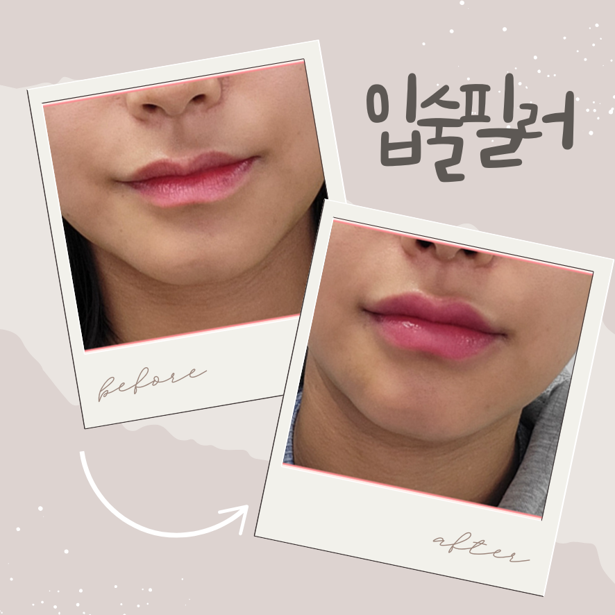 합정입술필러 Q&A: 통증&middot;비율&middot;비용 한눈에 관련 이미지 1