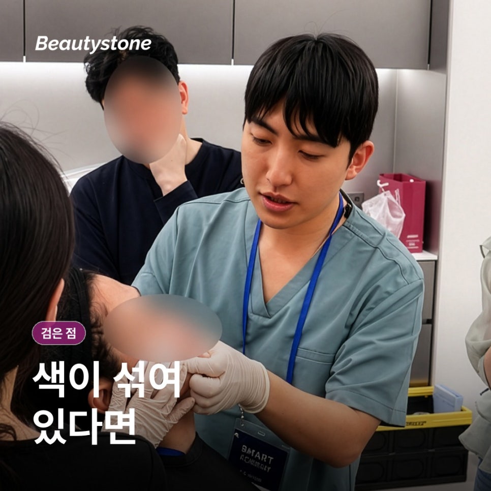 Can I Have a Black Spot Removed Right Away? What to Check Before Laser Treatment image 3