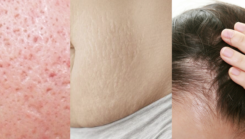 Gongdeok Dermatology, CUREJET Juvelook Pore Treatment: After How Many Sessions Will You Notice a Difference? image 2