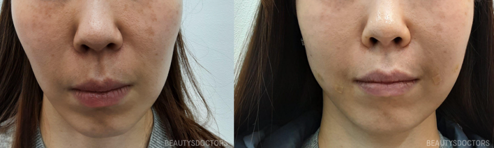 당산역 피부과 쥬베룩 볼륨 효과, 자연스럽게 차오르는 이유 관련 이미지 2