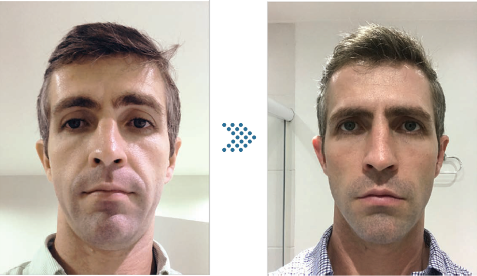 레디어스 시술 효과는 언제부터? 합정역피부과 관련 이미지 4