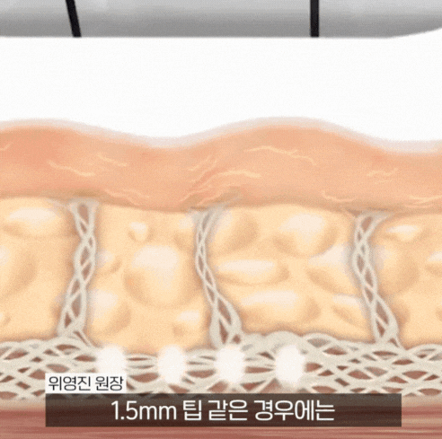 울쎄라 후 통증, 효과 부작용까지! 관련 이미지 2