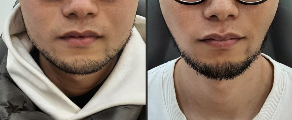 턱보톡스 효과 언제부터 나타날까? + 얼굴 볼살 빼는법 관련 이미지 4