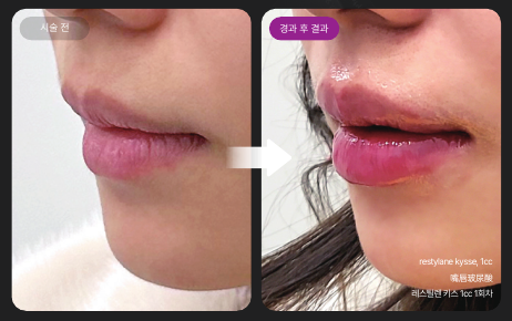 입꼬리올리기, 필러만으로 될까? 보톡스 필요한 경우 정리 관련 이미지 4