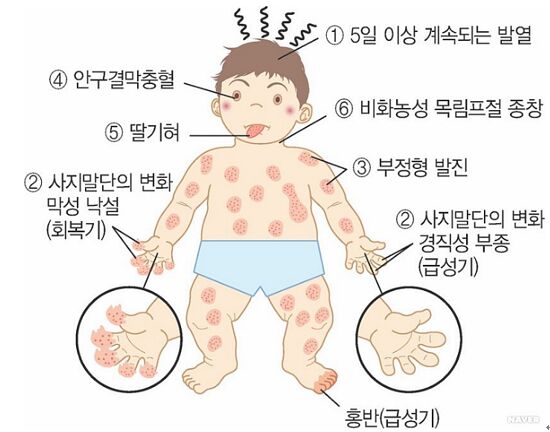 영국, 어린이 괴질 속출..증상은 관련 이미지 5