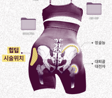 골반필러 잘하는 곳 어떻게 찾을까? 후기 (feat.힙딥필러) 관련 이미지 2