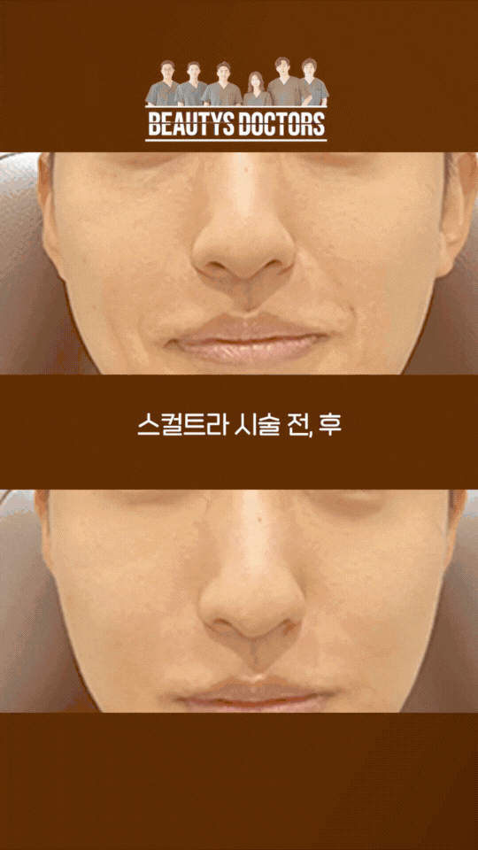 여의도역 피부과 볼 스컬트라 효과 후기로 알아보기 관련 이미지 2