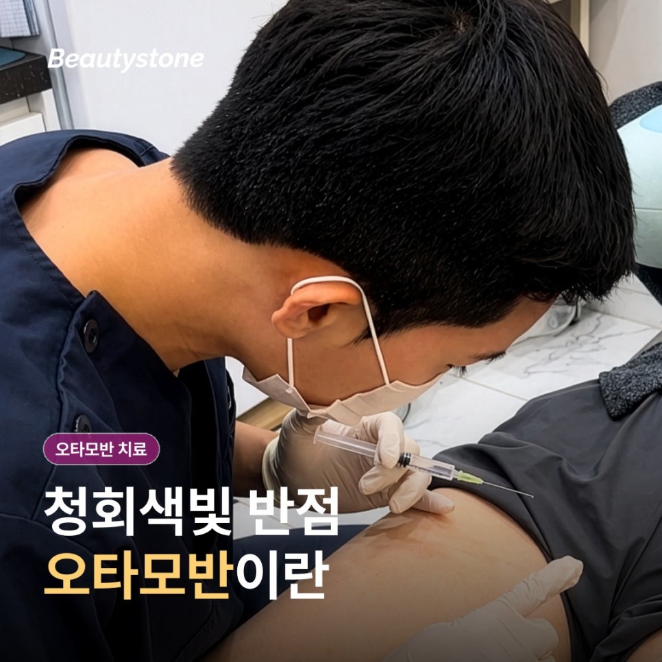 얼굴 푸른 점 오타모반 치료, 레이저 원리와 횟수&middot;시술 후 관리 관련 이미지 2