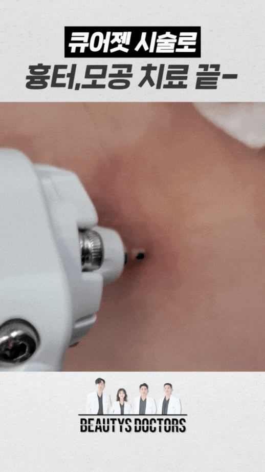 합정역 피부과, 큐어젯 쥬베룩으로 여드름 흉터개선 관련 이미지 4