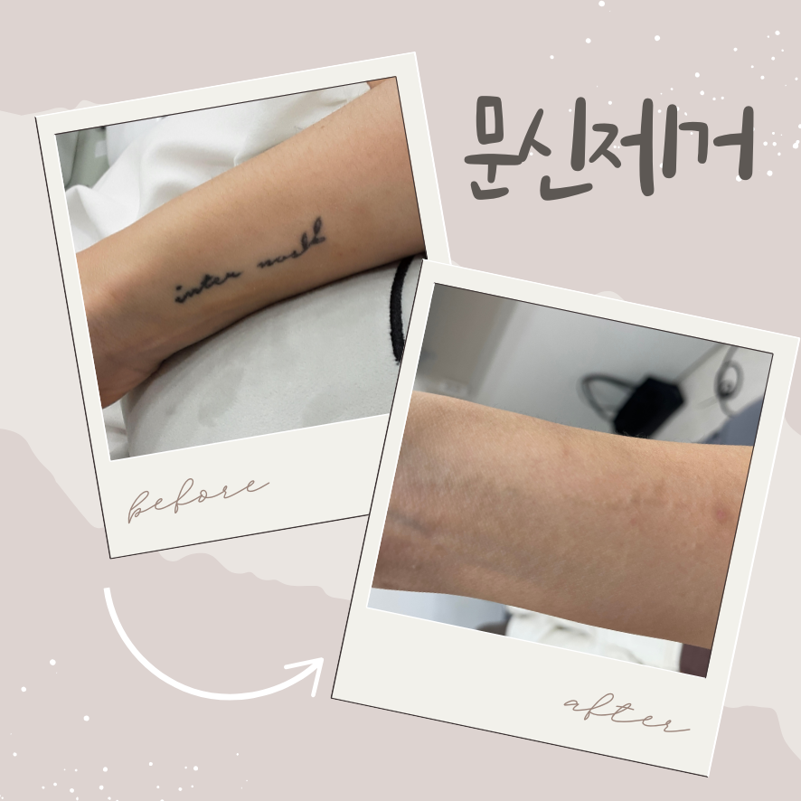 영등포 피부과 문신 제거, 정말 깨끗하게 지워질 수 있을까? 관련 이미지 1