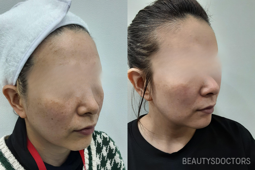 공덕역 피부과, 피코토닝 후기로 보는 색소 변화 관련 이미지 3