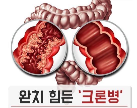 '미스터트롯' 가수 영기 크론병 투병중..크론병이란? 관련 이미지 2