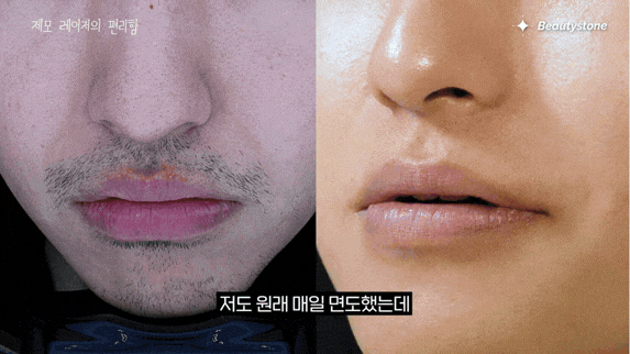 제모 왜 지금 해야할까?젠틀맥스프로플러스 효과&middot;횟수&middot;파장 차이 총정리 관련 이미지 2