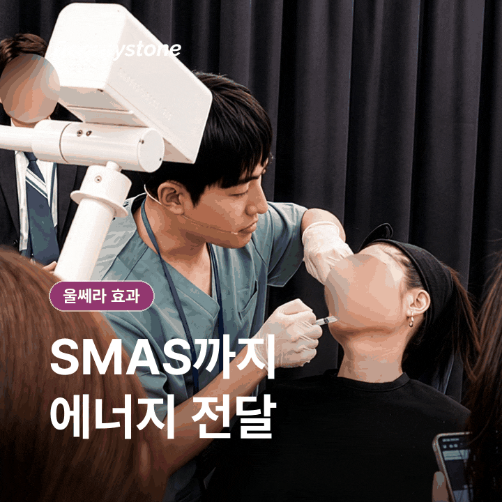 울쎄라 효과, 언제 어떻게 나타날까 관련 이미지 3