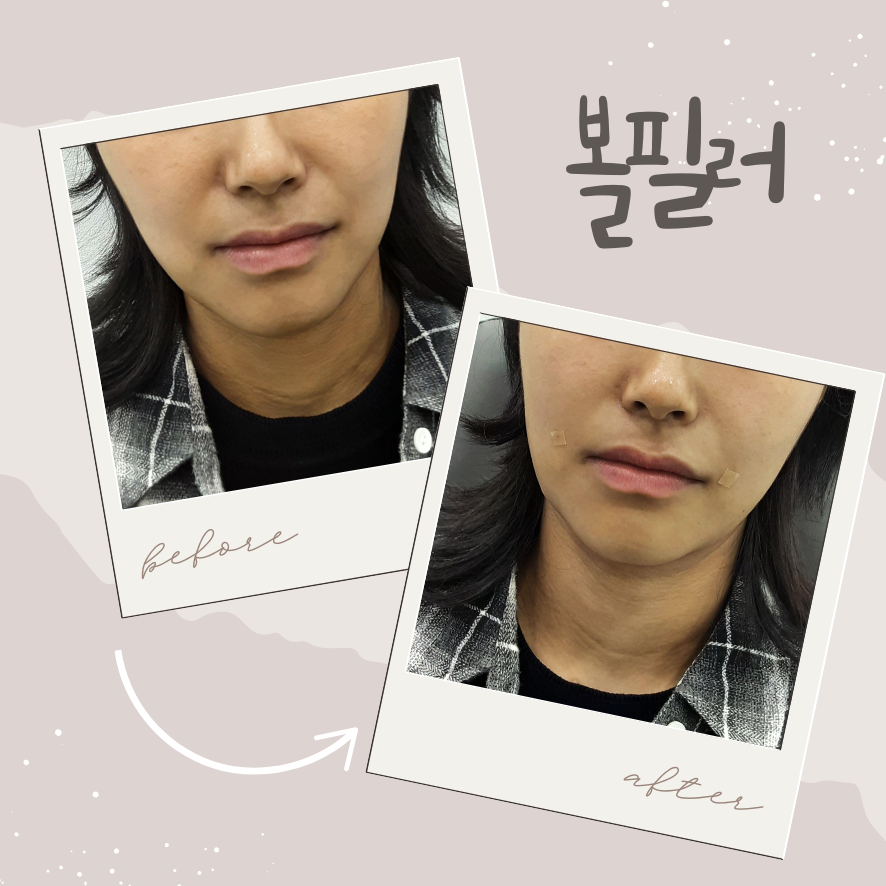 여의도 피부과 추천, 볼필러 결과가 달라지는 진짜 이유 관련 이미지 1