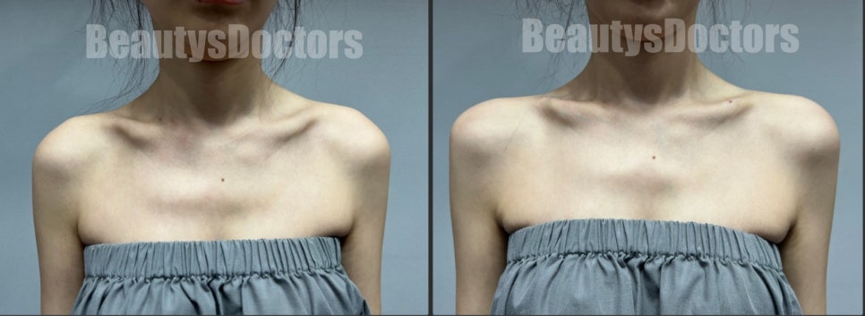 어깨필러와 승모근 보톡스의 황금 밸런스, 직각 어깨의 완성 관련 이미지 4