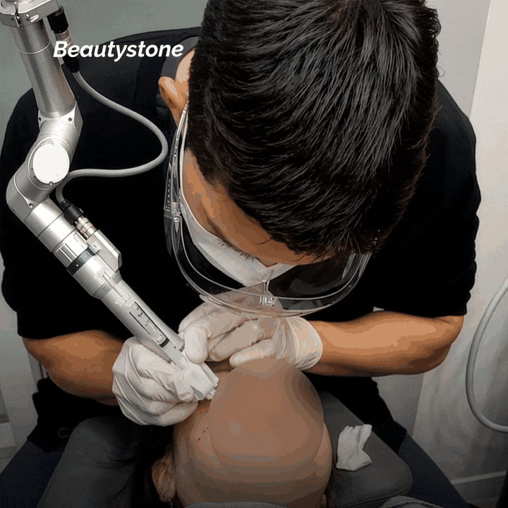 How V-Line Thread Lifting Works: What to Know Before the Procedure image 12