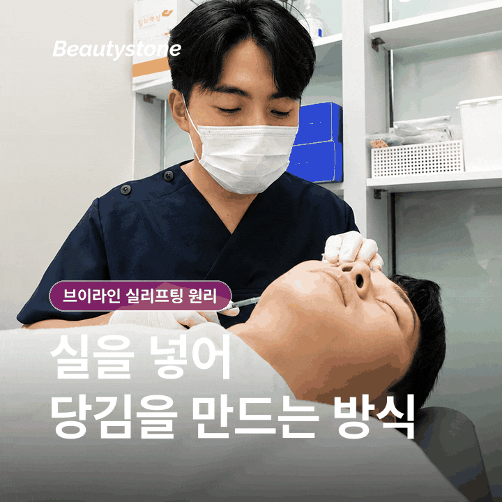How V-Line Thread Lifting Works: What to Know Before the Procedure image 3