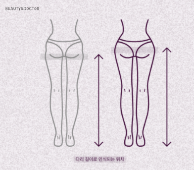 힙딥 고민 끝, 필러로 만드는 자연스러운 골반 라인 관련 이미지 6