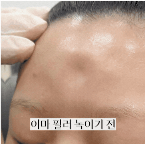 합정 이마필러 후기 속 붓기와 통증, 일상생활 복귀는 언제부터 가능할까? 관련 이미지 4