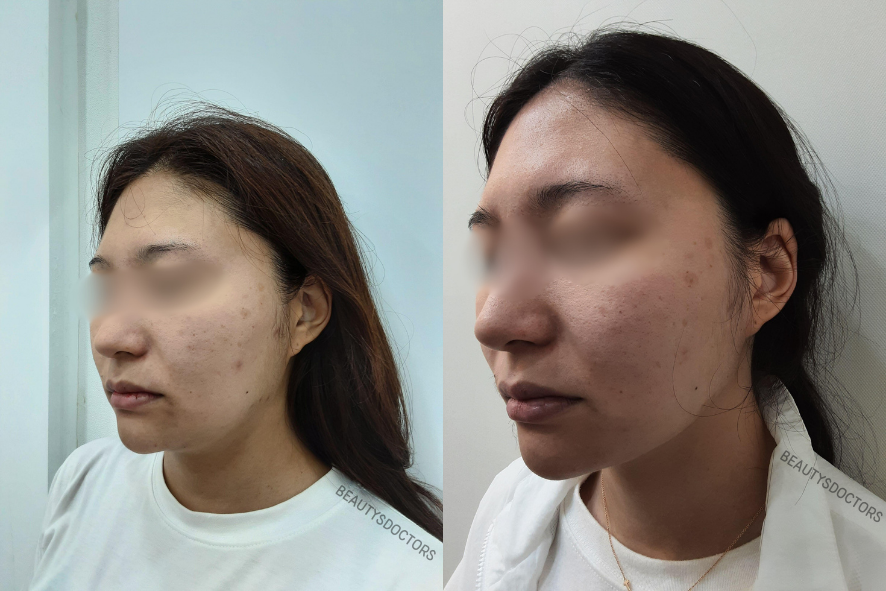 합정 피부과 울써마지 효과 총정리, 가격 비교부터 부작용 체크까지 관련 이미지 2