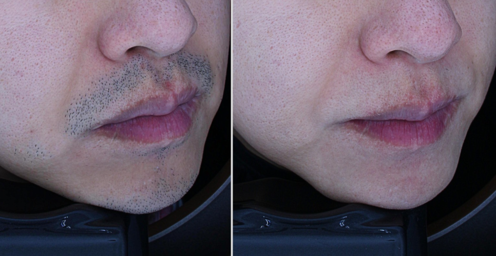 당산 피부과, 남자 여자 인중레이저 제모 차이는? 화장여부까지 관련 이미지 4