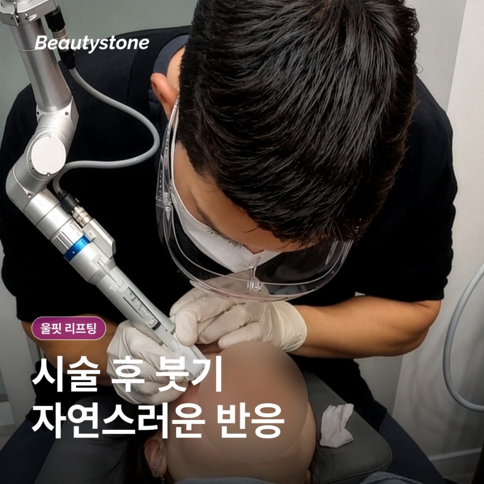 울핏 리프팅, 초음파 원리와 회복 관리 담담히 정리 관련 이미지 6