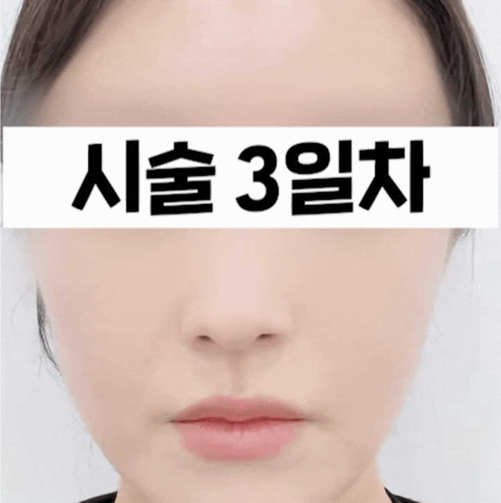 신촌 피부과 리쥬란 힐러 효과, 1주간의 변화 관련 이미지 3