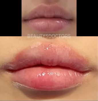 입술필러 통증 고통 어느정도일까? 1cc로 보는 후기 관련 이미지 2