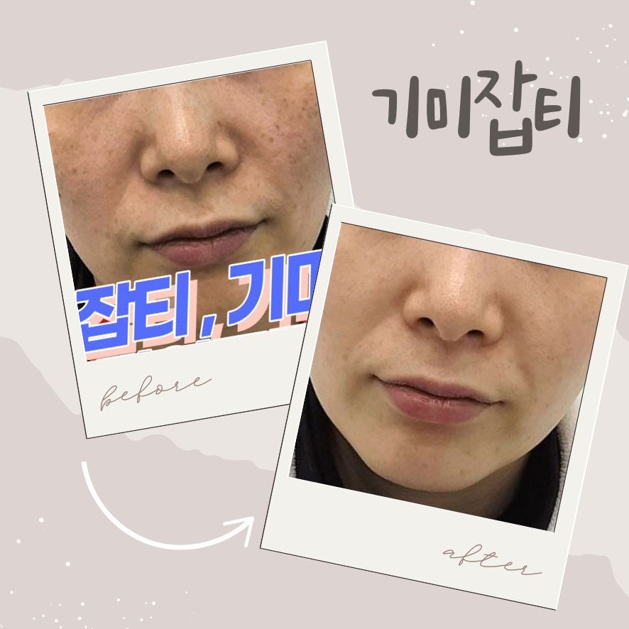 신촌역 피부과 기미&middot;잡티 레이저 제거, 피코토닝 언제가 적기일까 관련 이미지 1