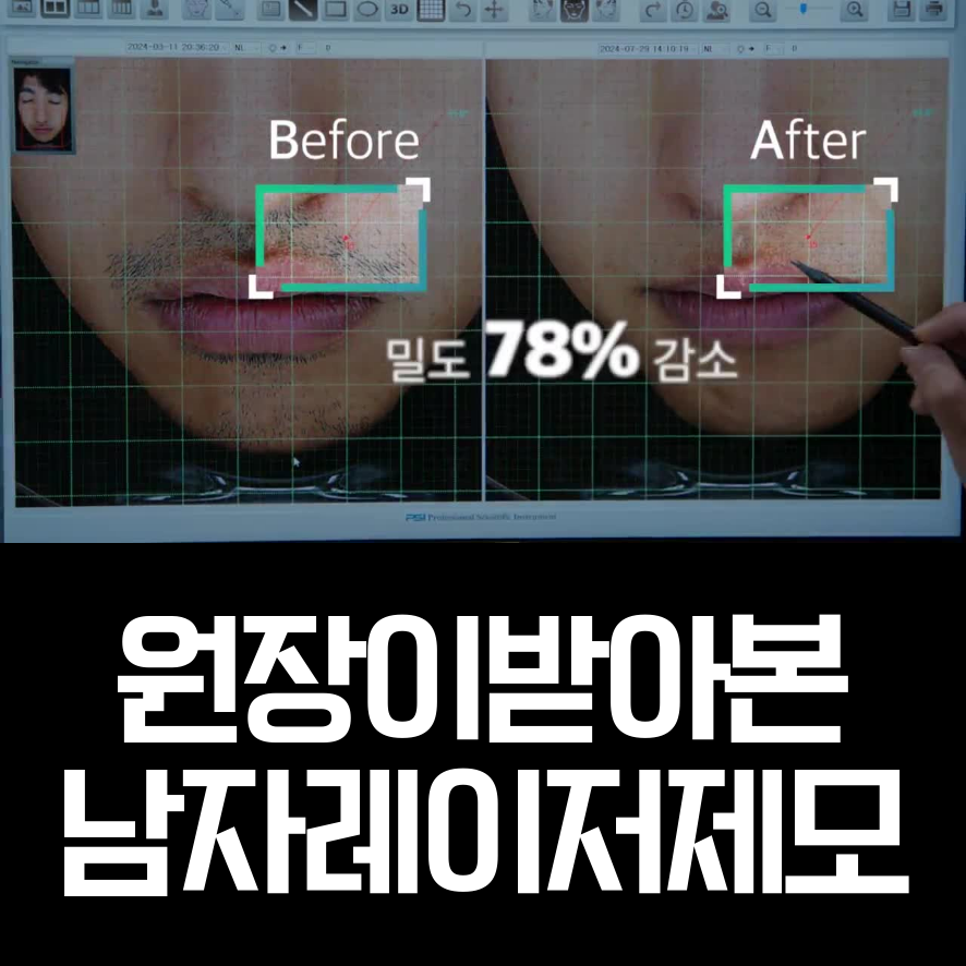 남자수염레이저 제모, 면도후트러블 해결한 리얼 경험담 관련 이미지 1