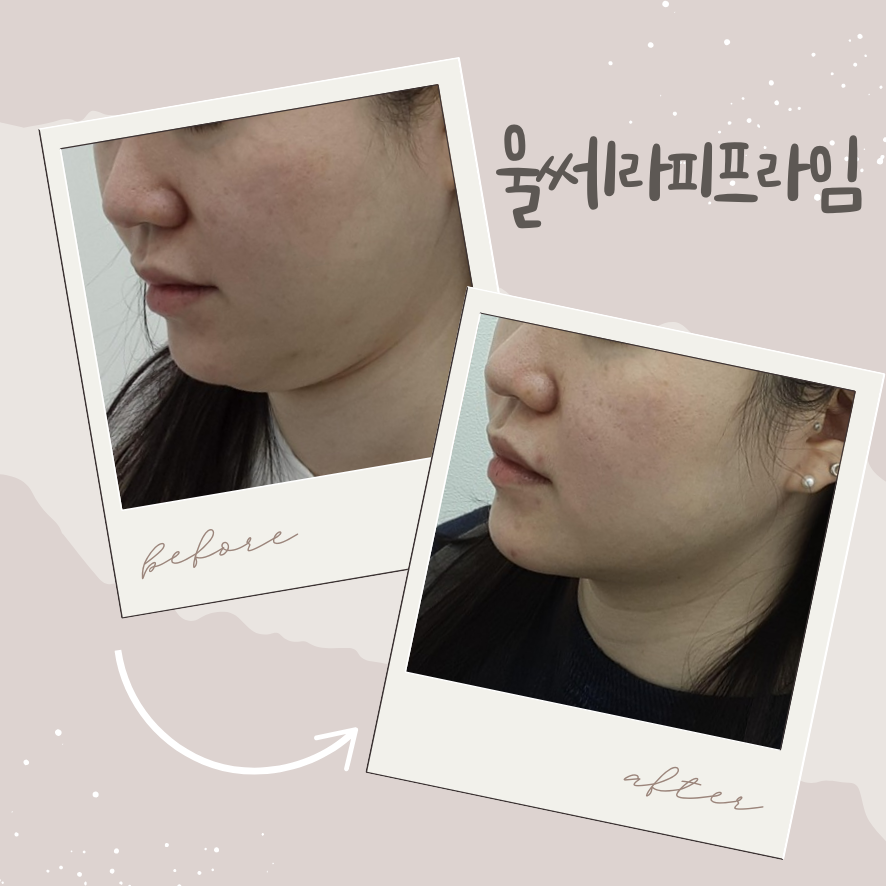 울쎄라피프라임, 실패 없는 리프팅을 위한 10가지 솔직 답변 관련 이미지 1