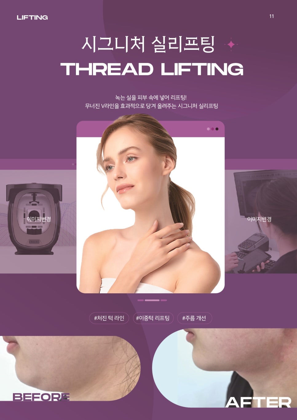 잼버실 중요한 이유, 실리프팅 부작용 최소화 관련 이미지 4