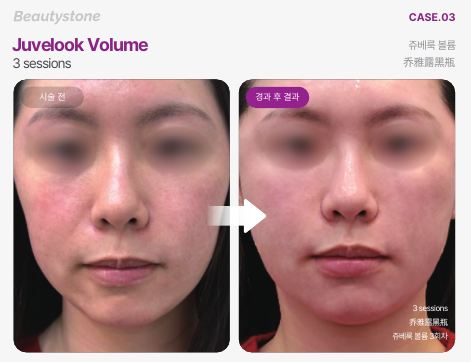 쥬베룩볼륨 효과 제대로 보려면? 결절 원인과 예방 포인트 관련 이미지 2