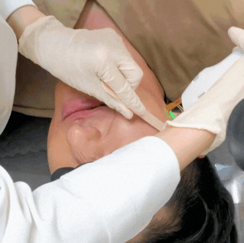 홍대 수염 제모, 젠틀맥스프로플러스로 직접 받아본 후기 관련 이미지 4