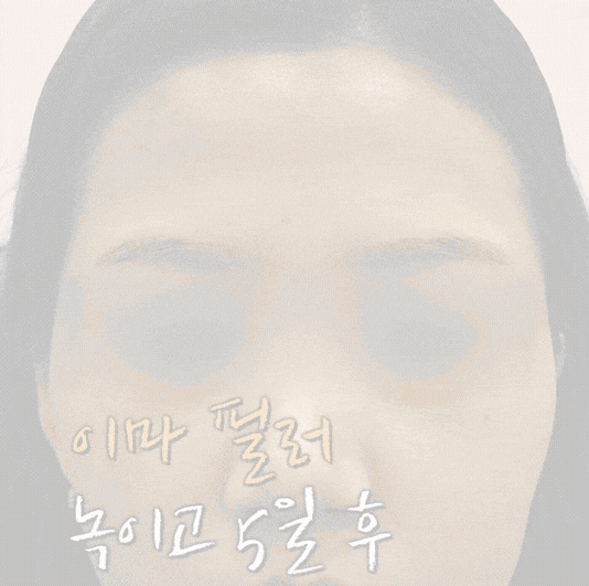 파주 피부과 이마필러 잘하는 곳, 후기를 통해 알아보 관련 이미지 3